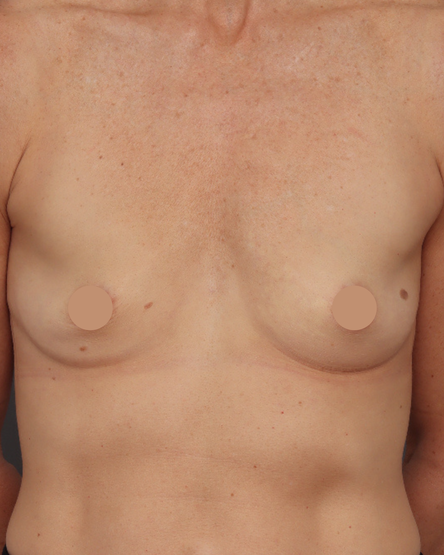Breast Augmentation - Before