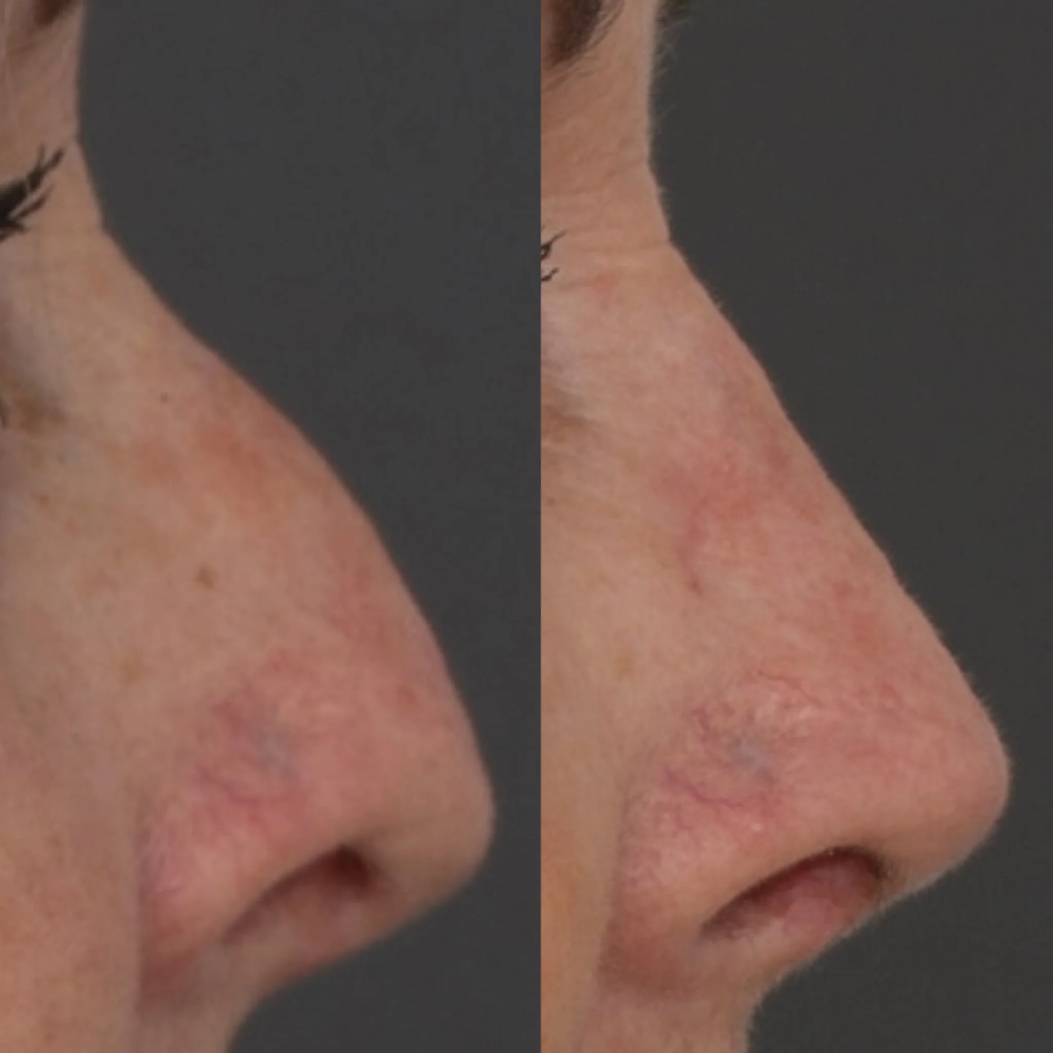 Rhinoplasty - Before and After