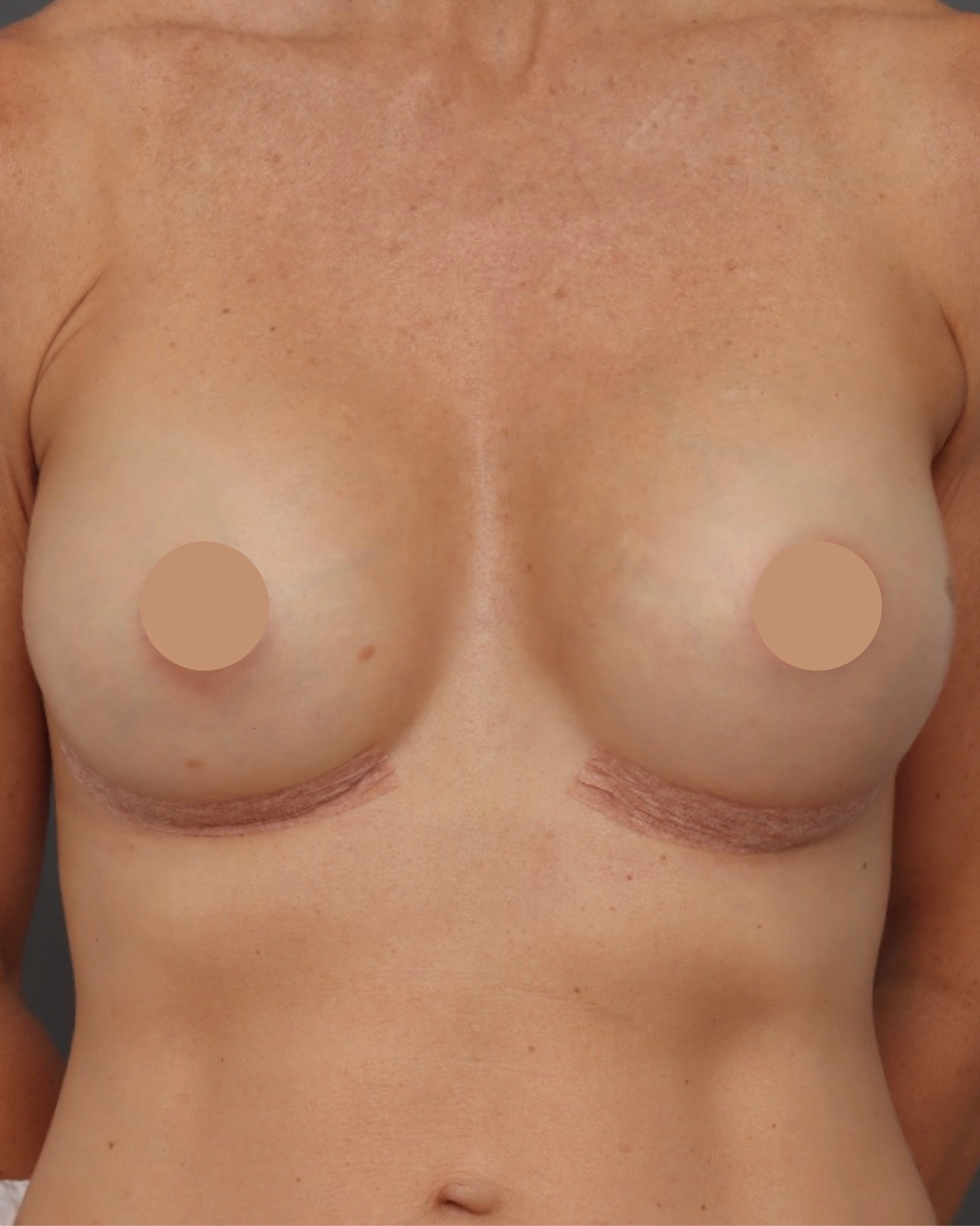 Breast Augmentation - After
