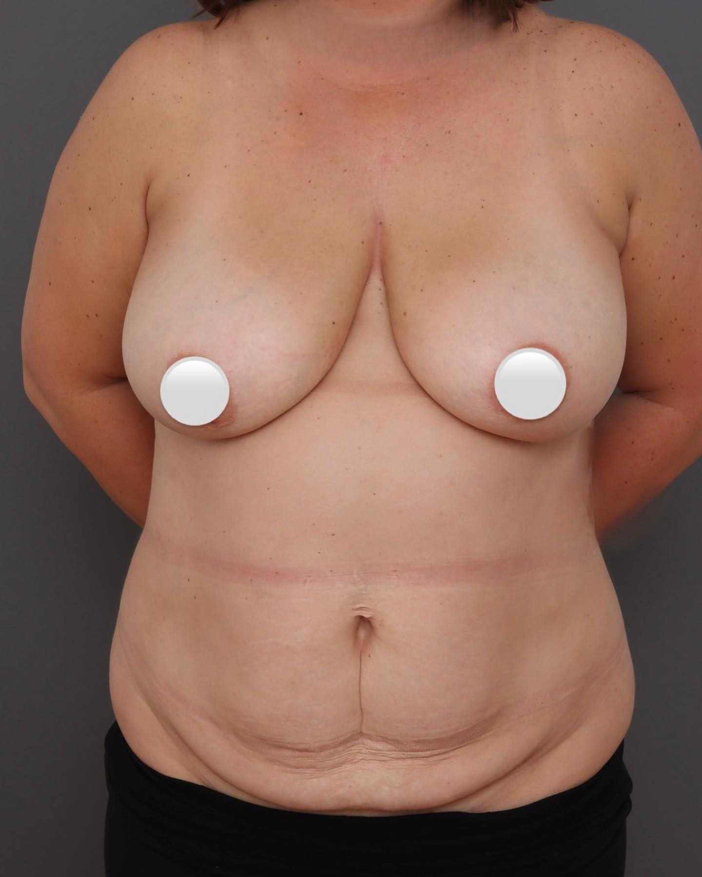 Abdominoplasty - Before