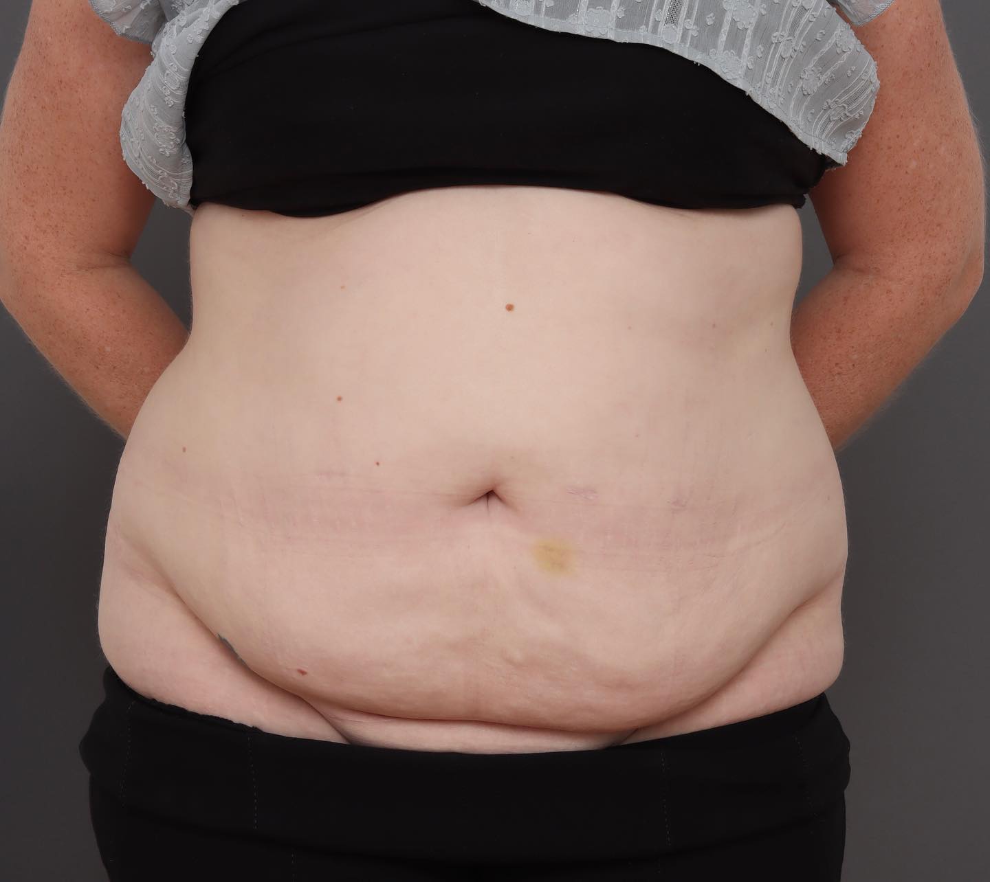 Abdominoplasty - Before