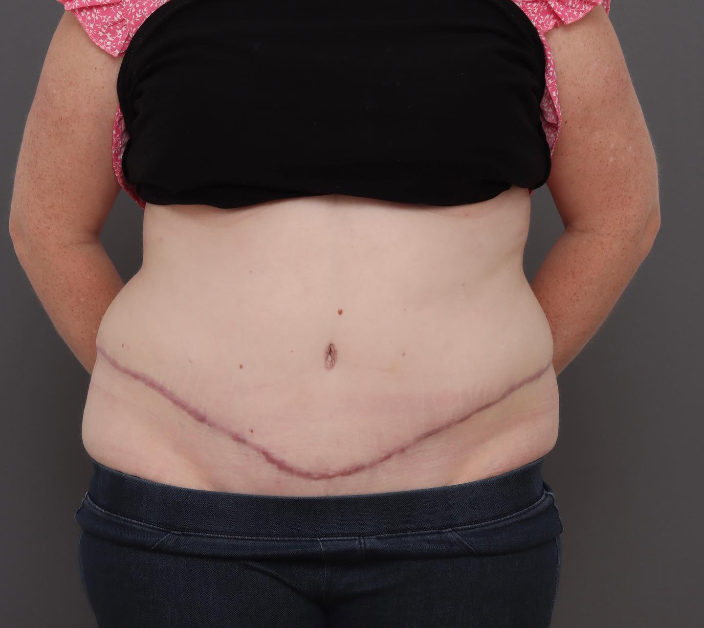 Abdominoplasty - After