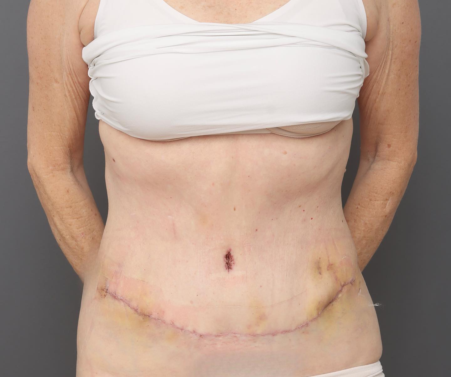 Abdominoplasty - After