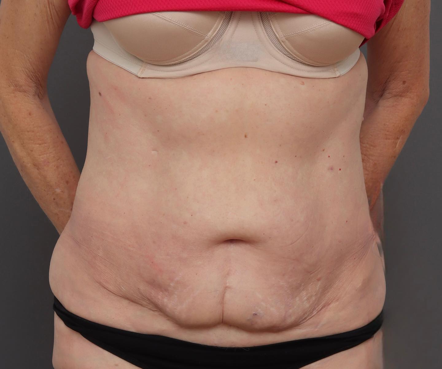 Abdominoplasty - Before