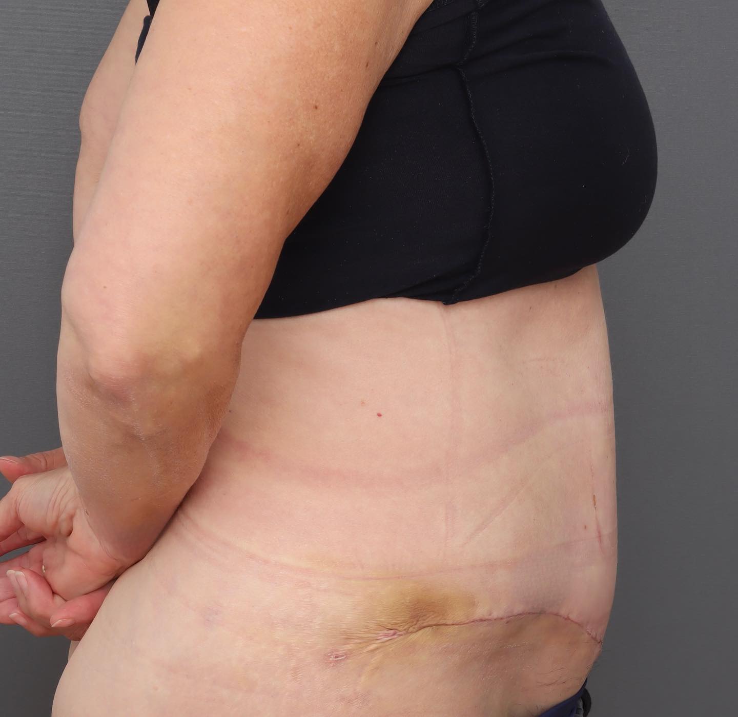 Abdominoplasty - After