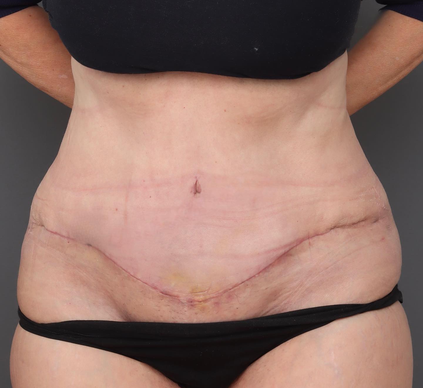 Abdominoplasty - After