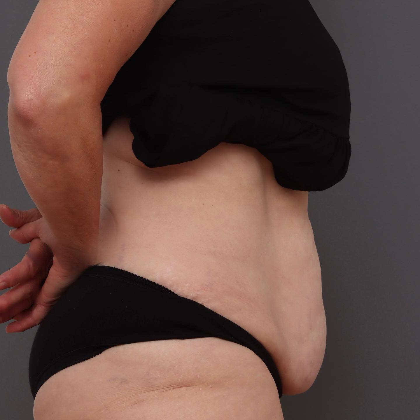 Abdominoplasty - Before