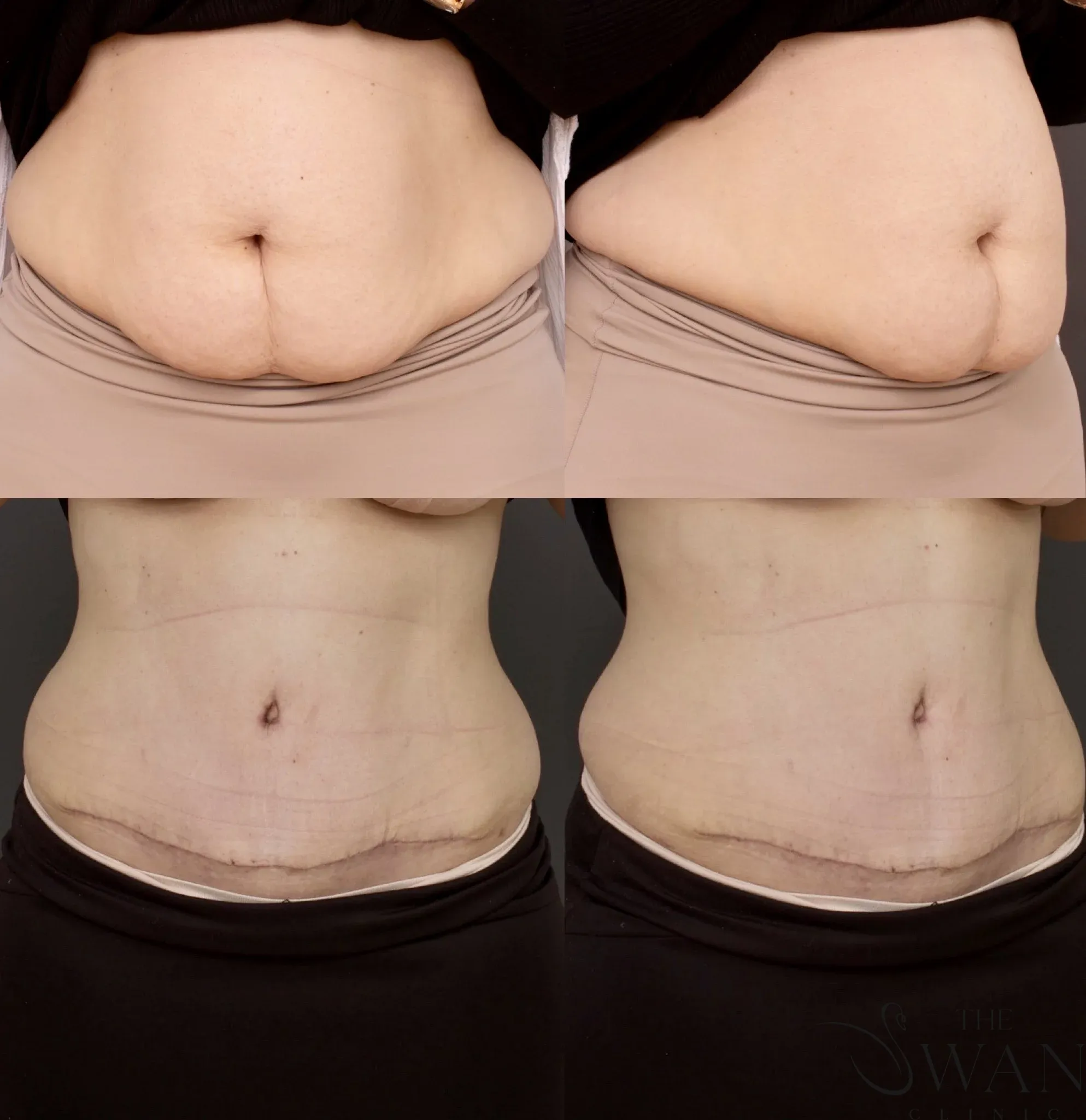 Abdominoplasty - Before and After