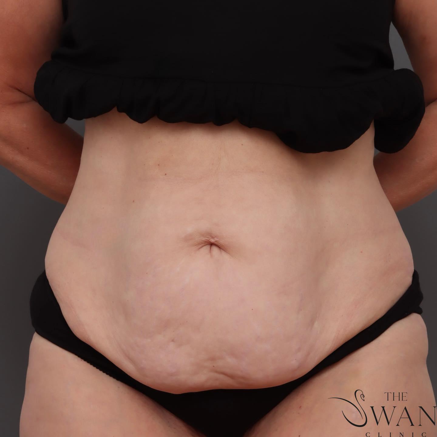 Abdominoplasty - Before