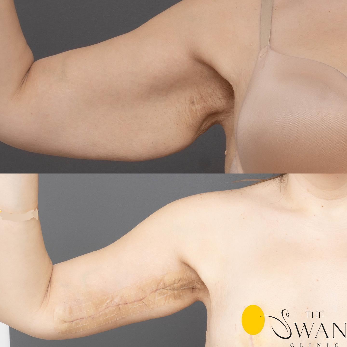 Brachiaplasty - Before and After