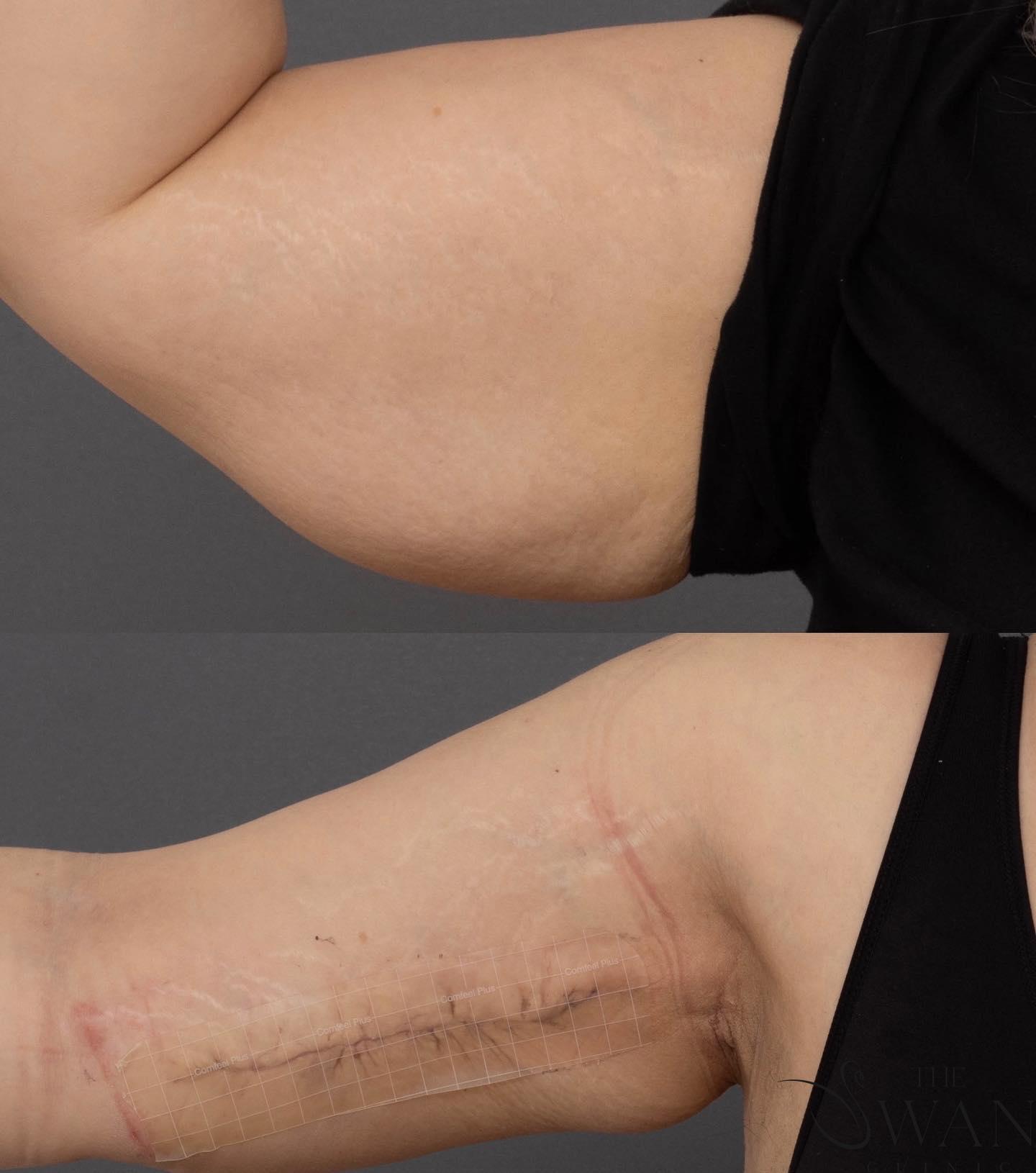 Brachiaplasty - Before and After