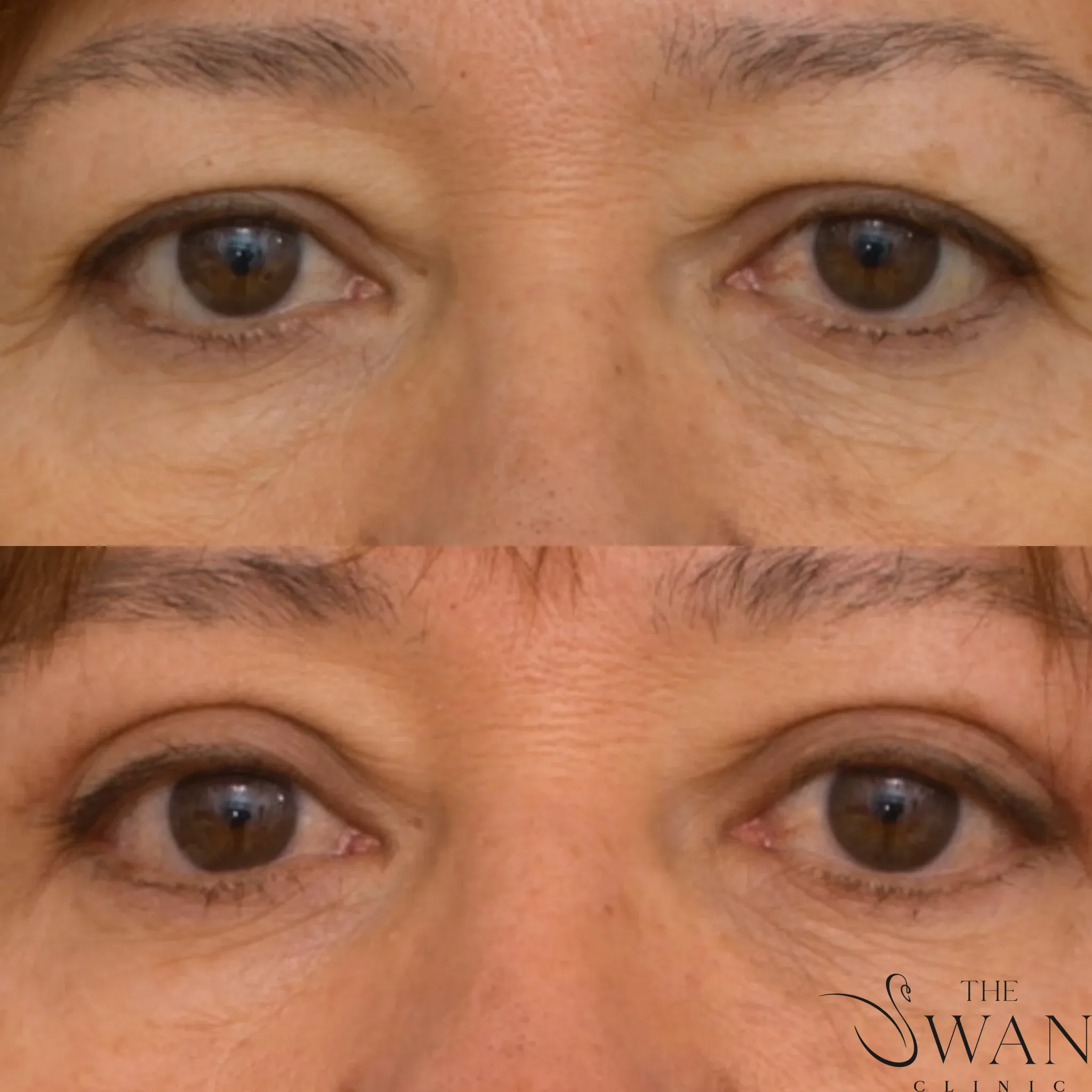 Blepharoplasty - Before and After