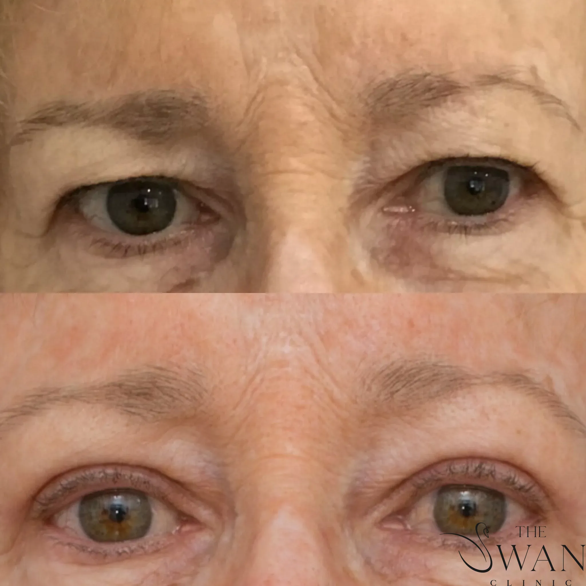 Blepharoplasty - Before and After
