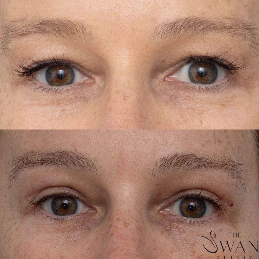 Blepharoplasty - Before and After