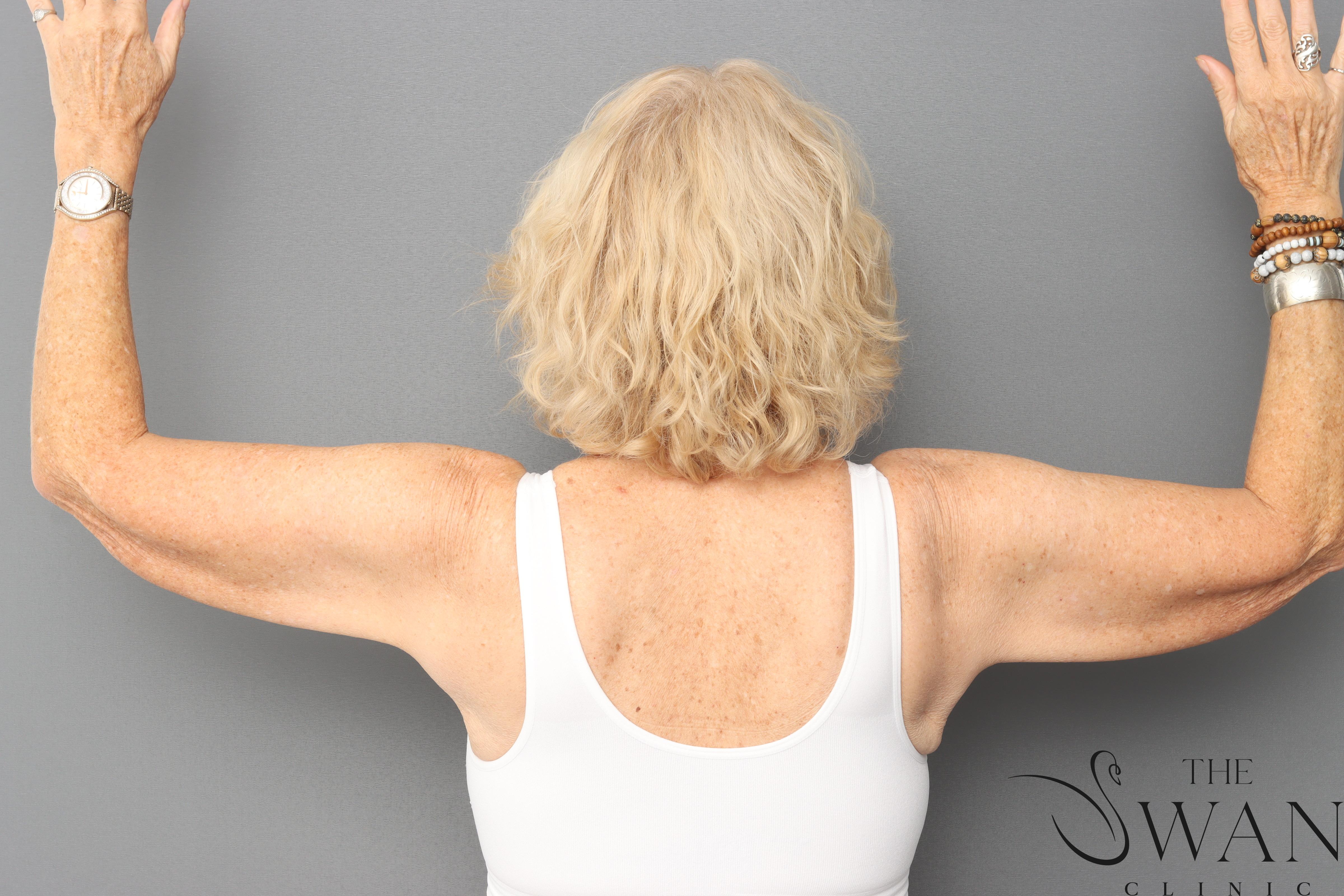 Brachiaplasty - Before