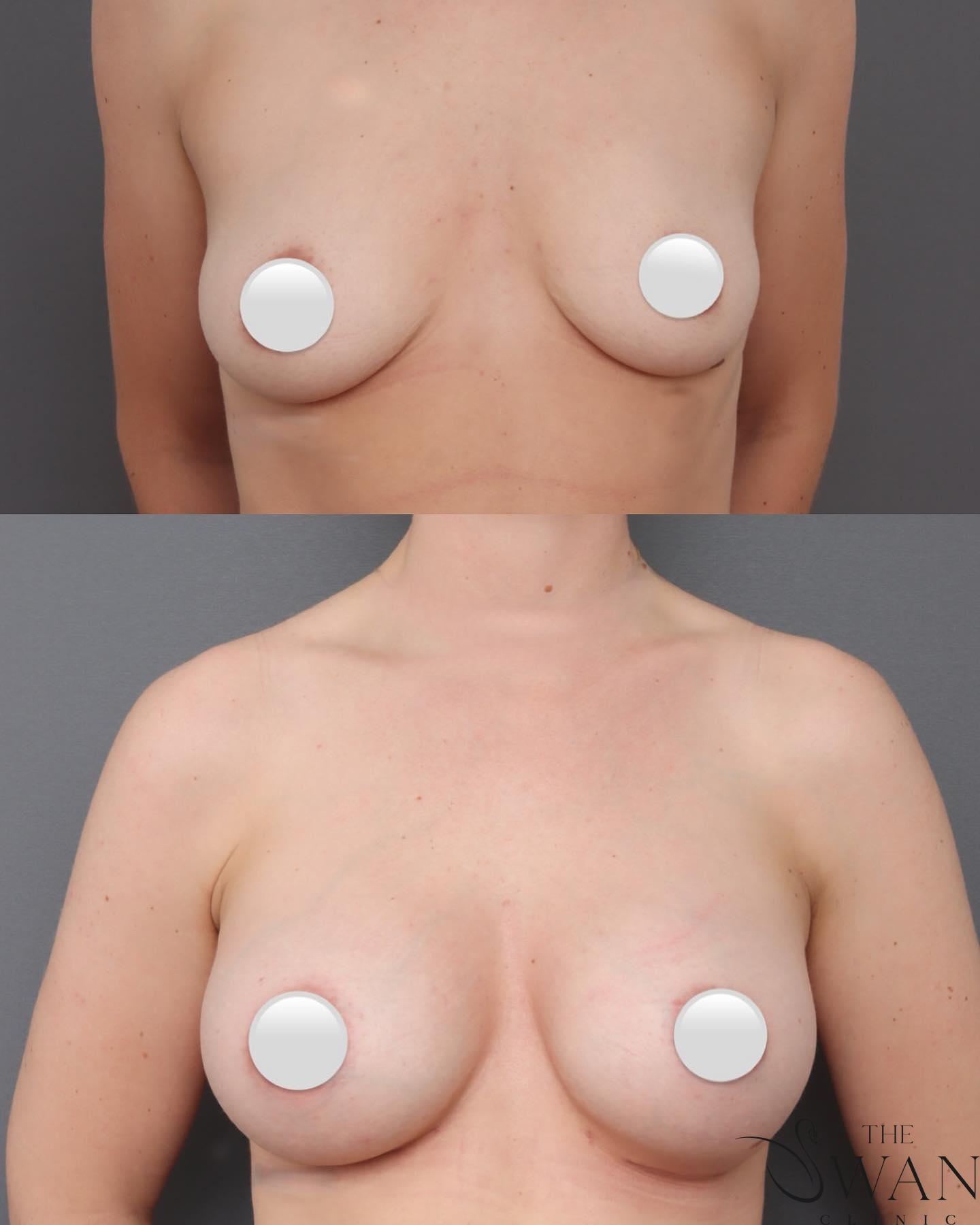 Breast Augmentation - Before and After