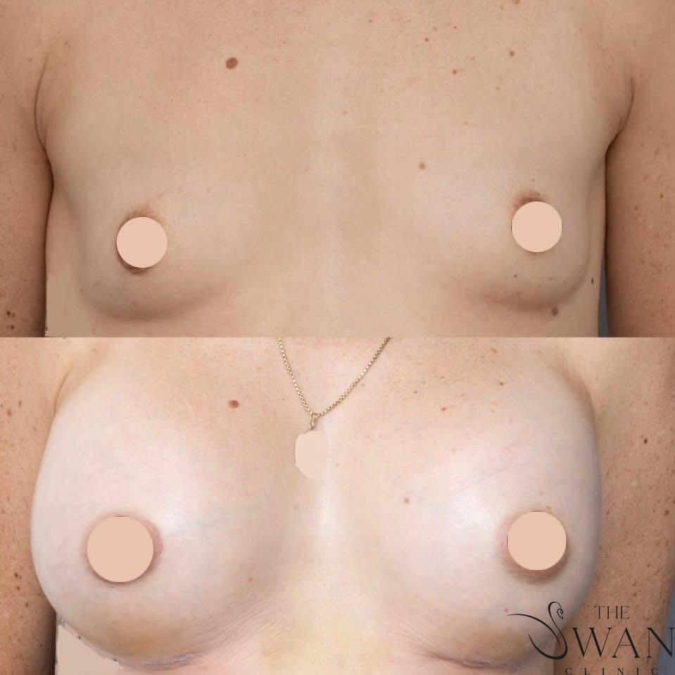 Breast Augmentation - Before and After
