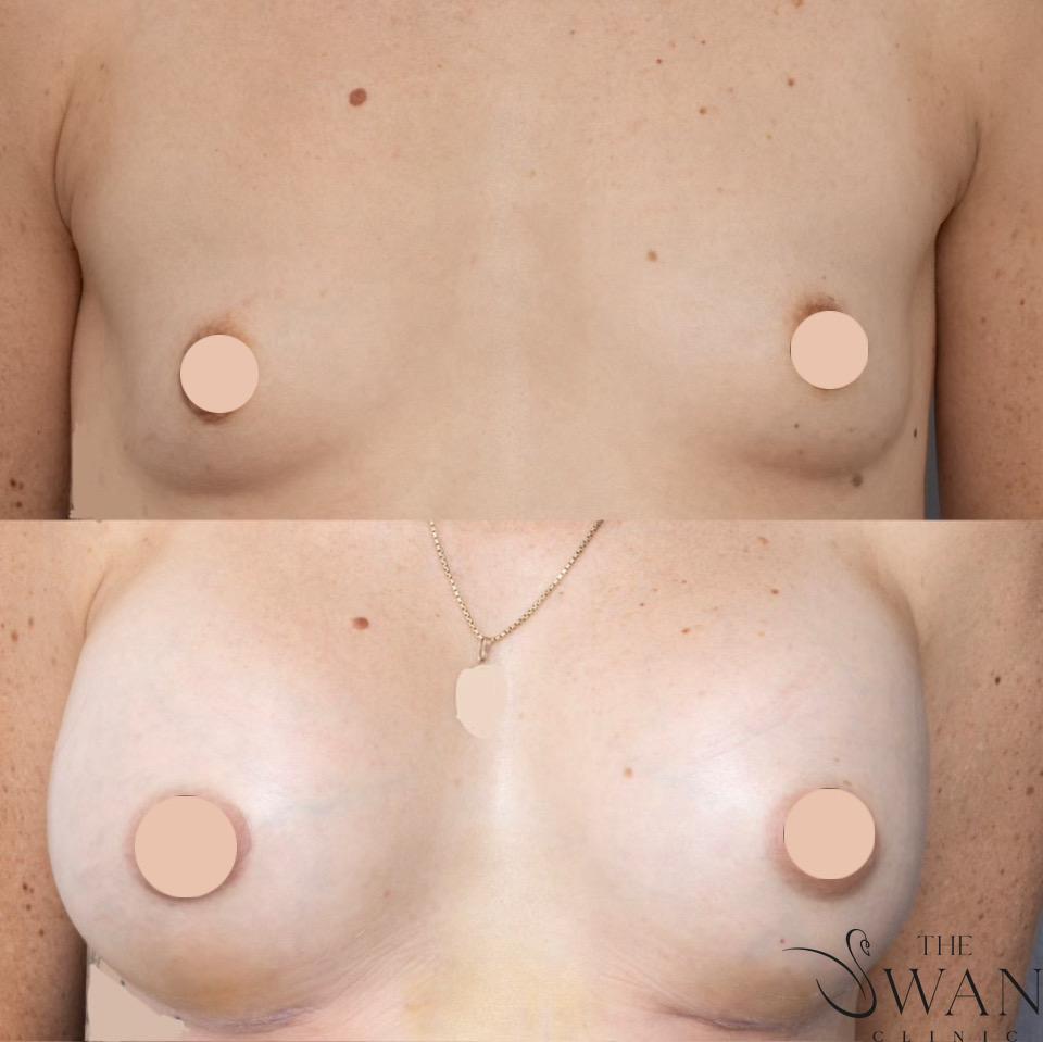 Breast Augmentation - Before and After