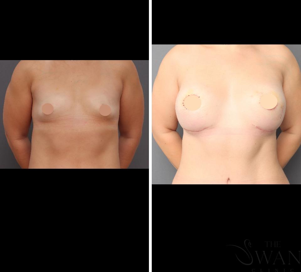 Breast Augmentation Mastopexy - Before and After