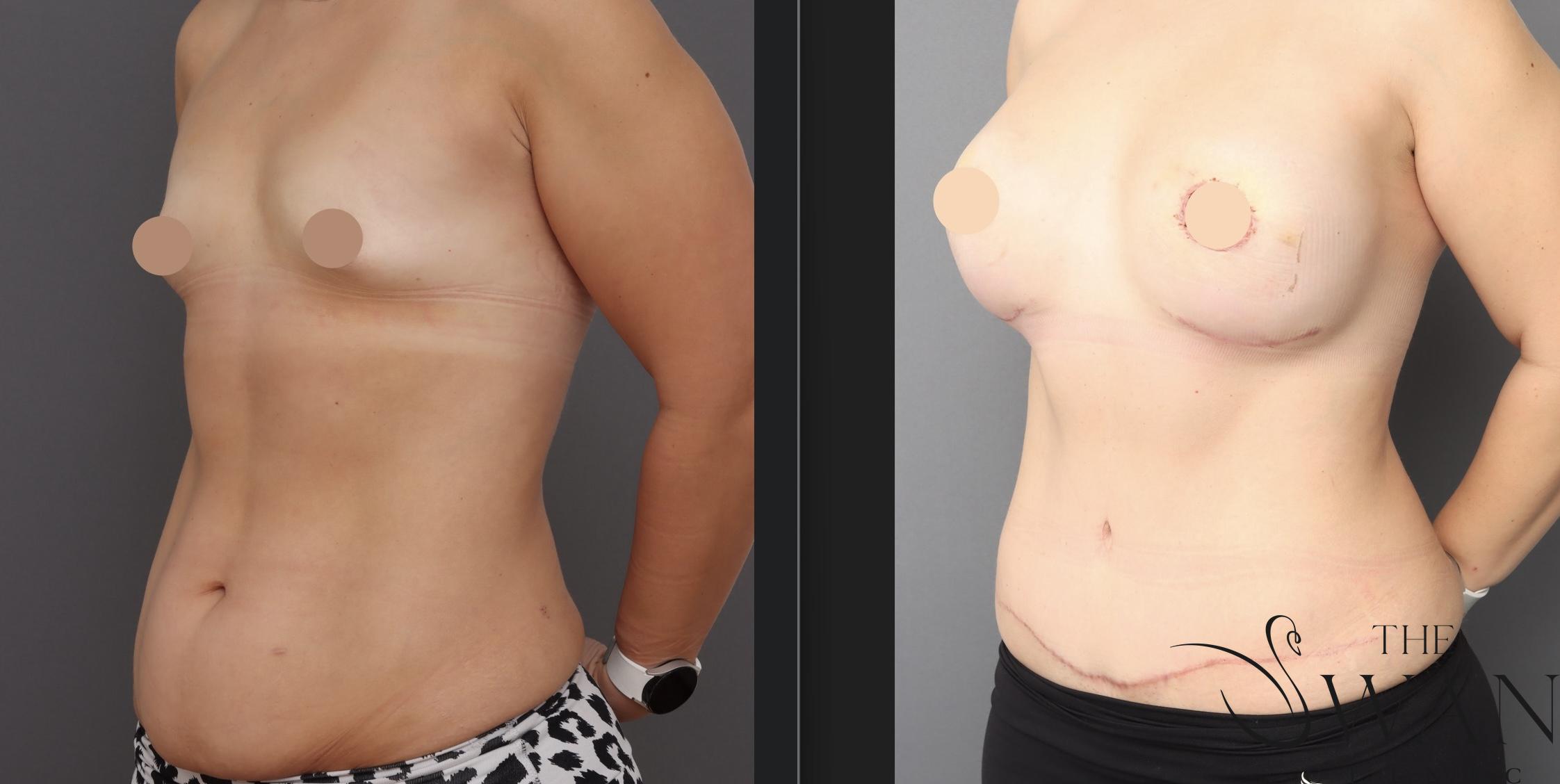 Breast Augmentation Mastopexy - Before and After