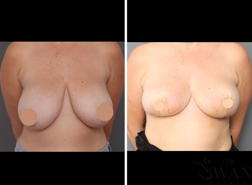 Reduction Mammoplasty - Before and After