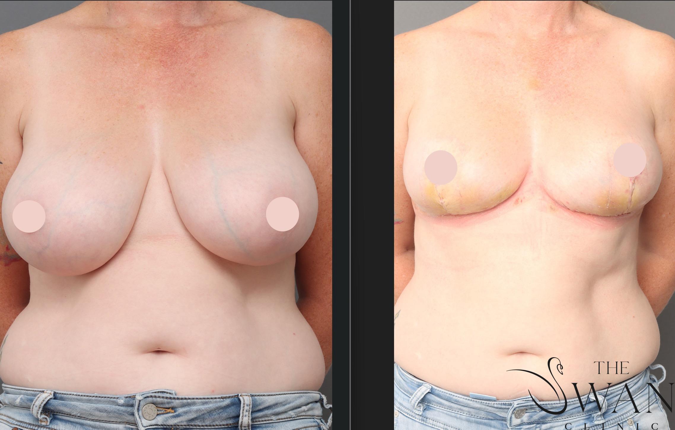 Reduction Mammoplasty - Before and After