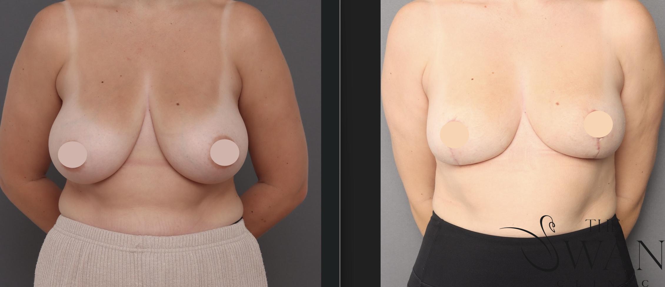 Reduction Mammoplasty - Before and After