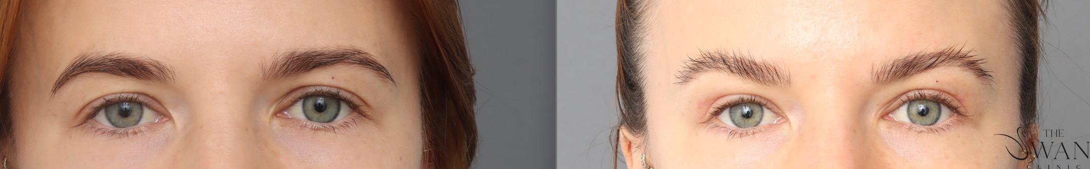 Browplasty Surgery - Before and After