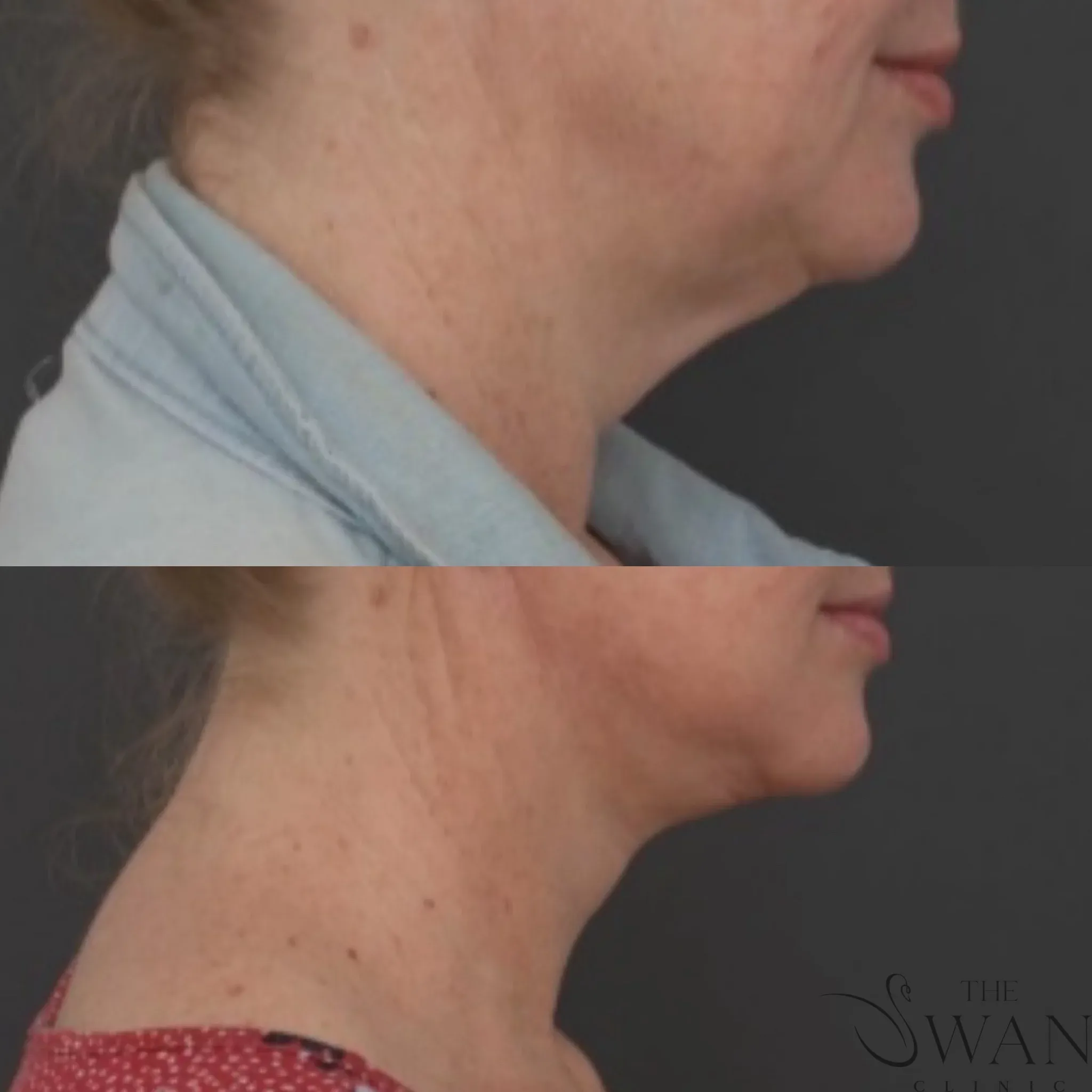 Meloplasty Surgery - Before and After