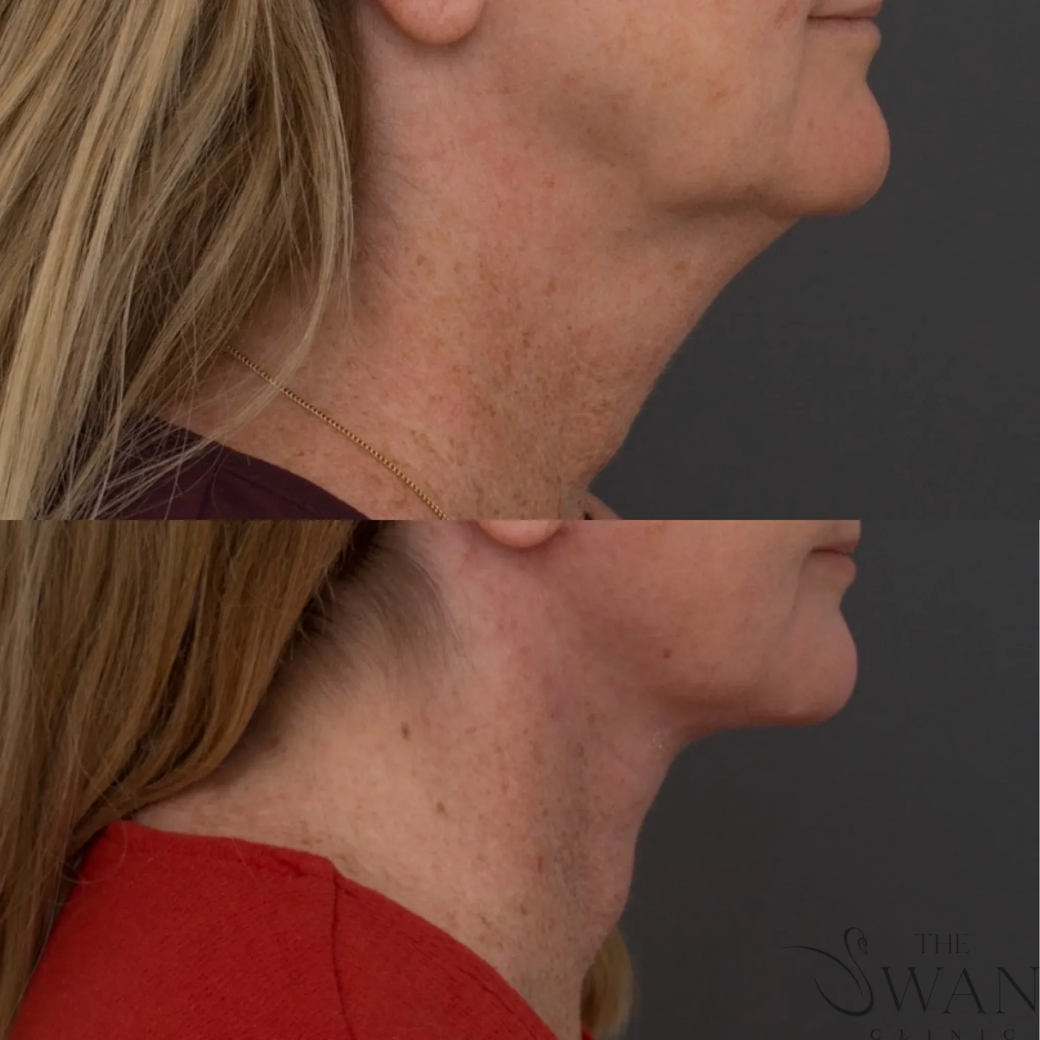 Platysmaplasty - Before and After