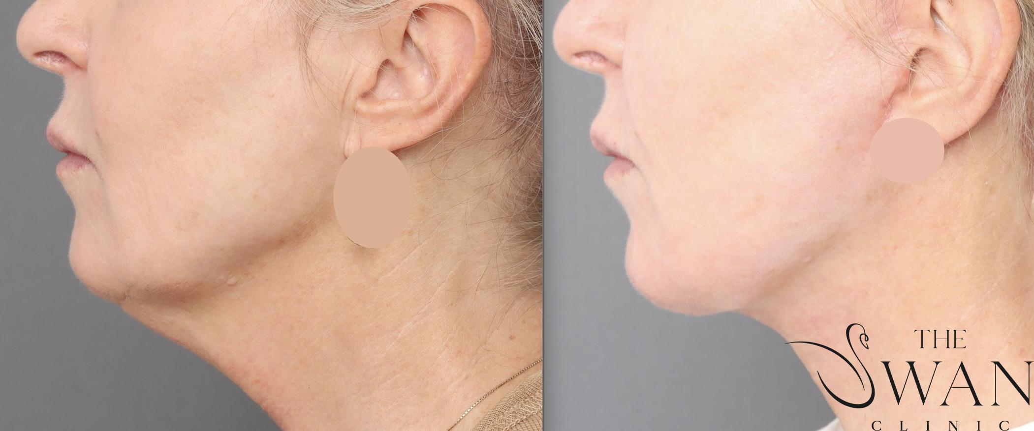 Platysmaplasty - Before and After