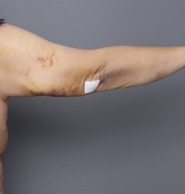 Brachiaplasty - After