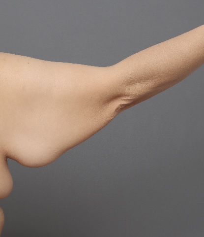 Brachiaplasty - Before