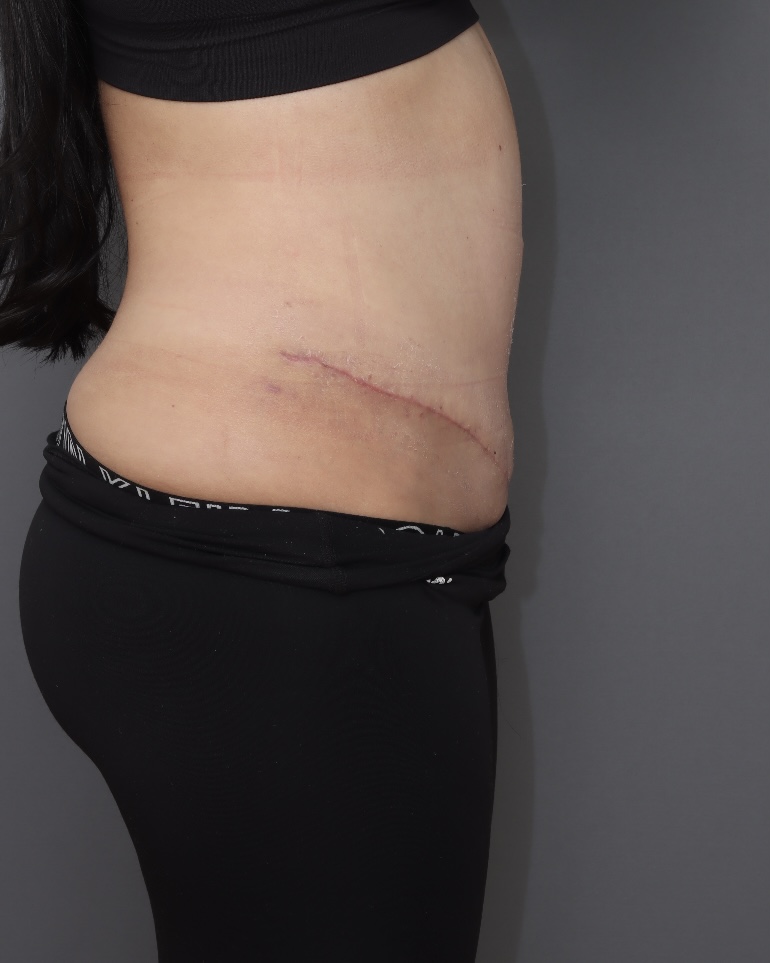 Abdominoplasty - After