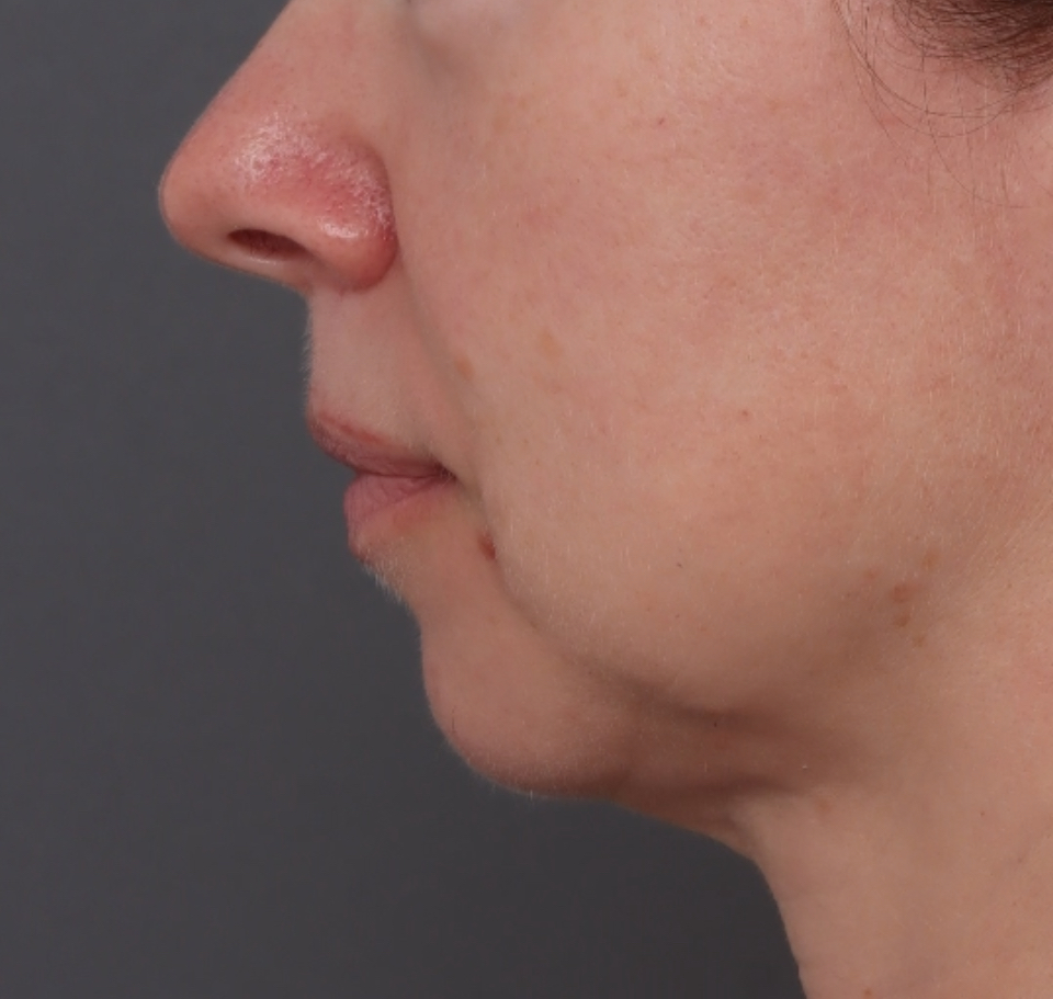 Genioplasty - Before