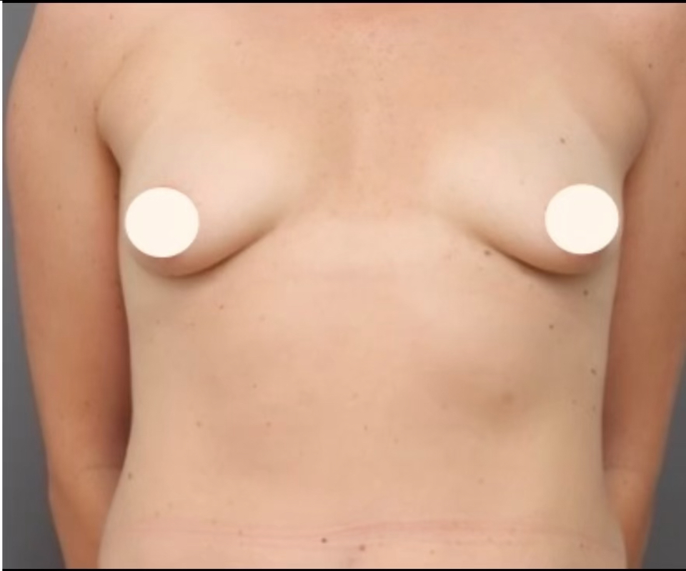 Mastopexy - Before