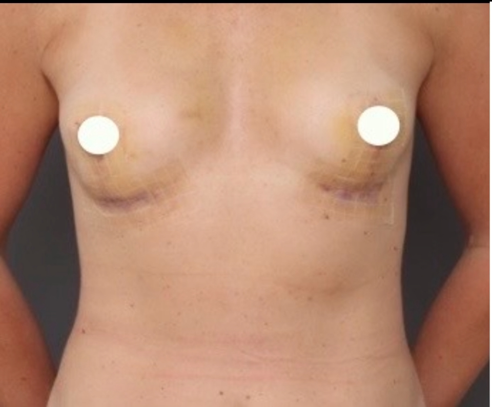 Mastopexy - After