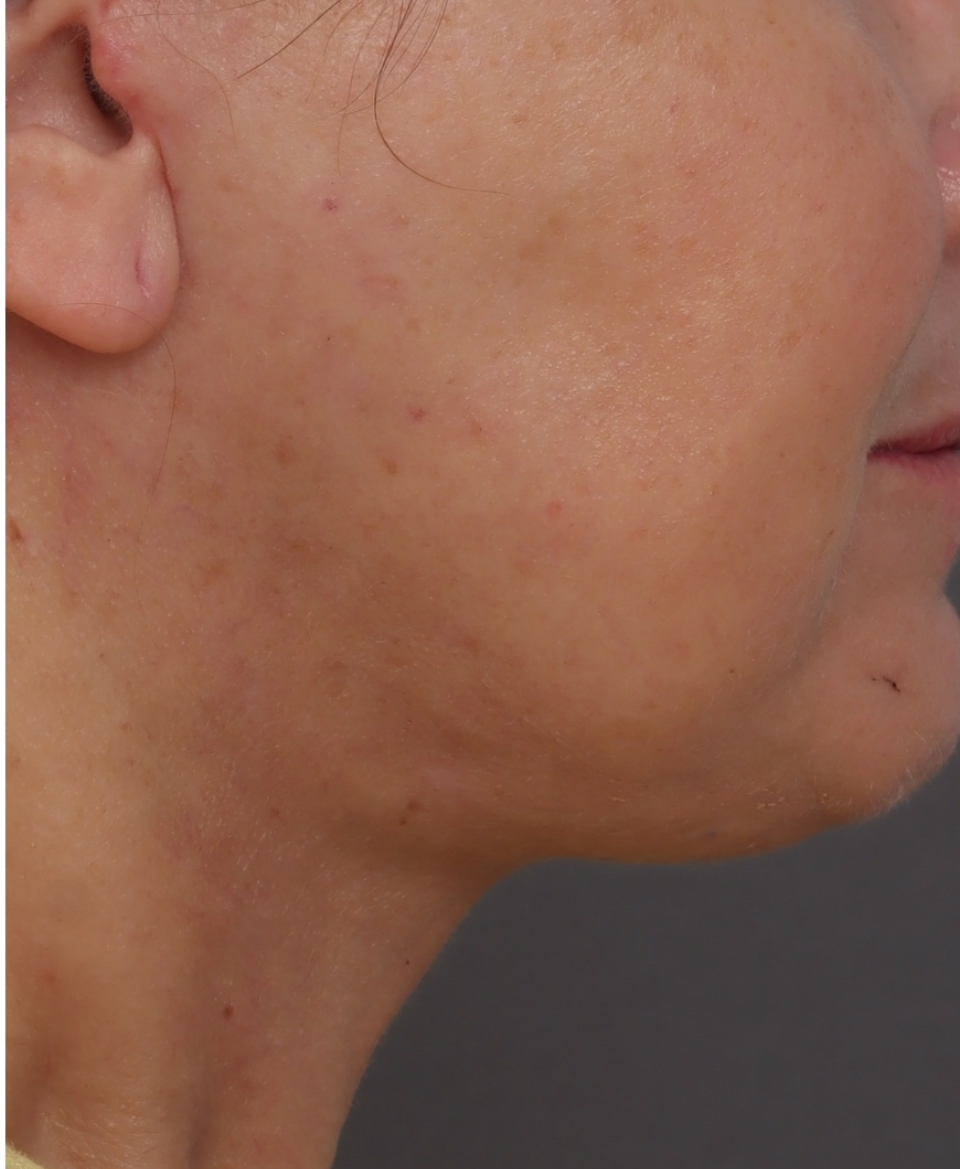 Platysmaplasty - After