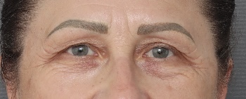 Blepharoplasty - Before