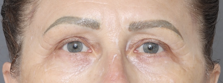 Blepharoplasty - After