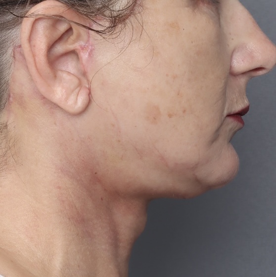 Platysmaplasty - After