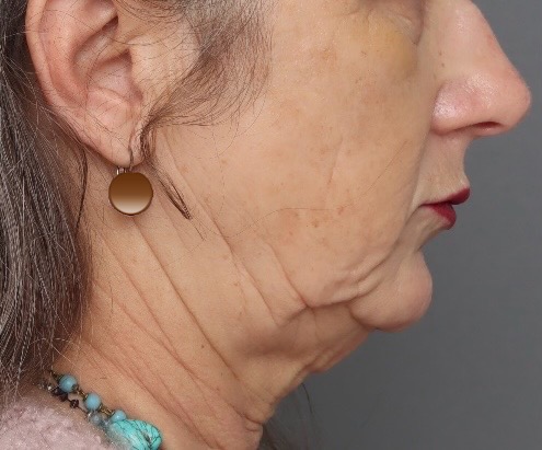 Platysmaplasty - Before