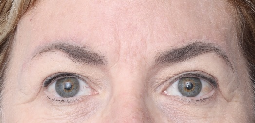 Browplasty Surgery - After