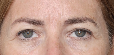 Browplasty Surgery - Before