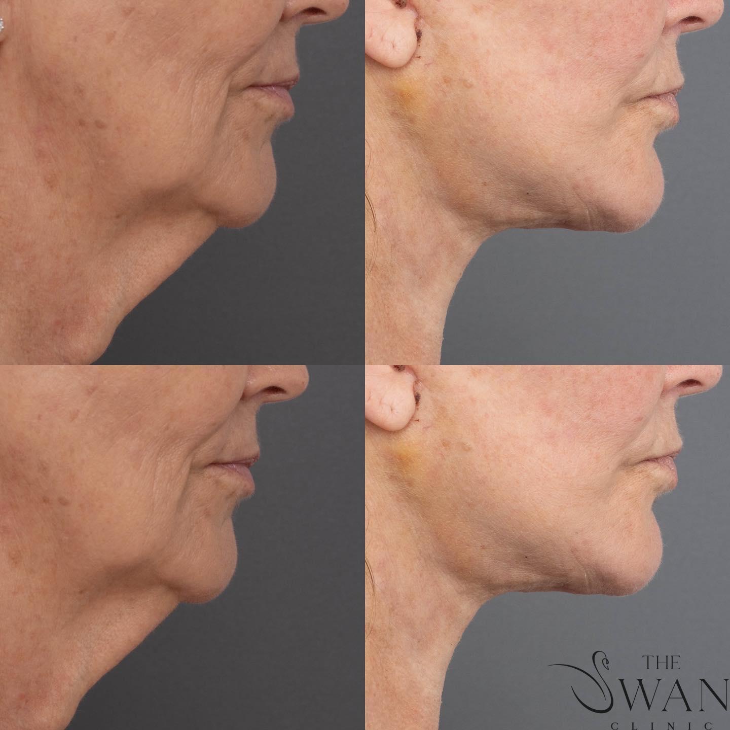Meloplasty Surgery - Before and After
