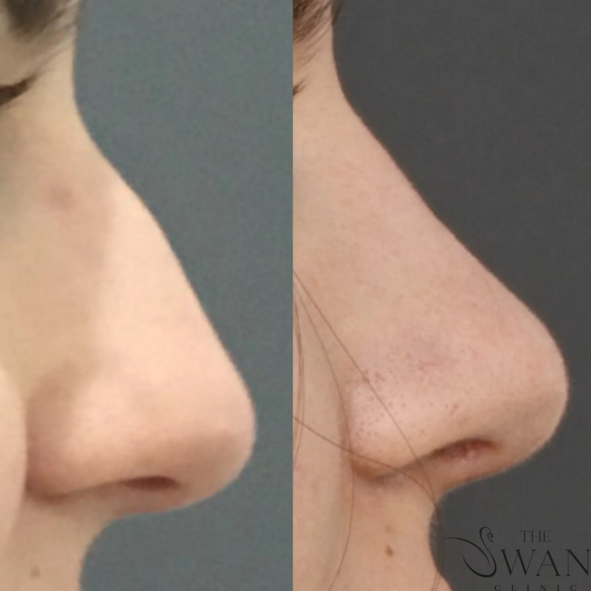 Rhinoplasty - Before and After