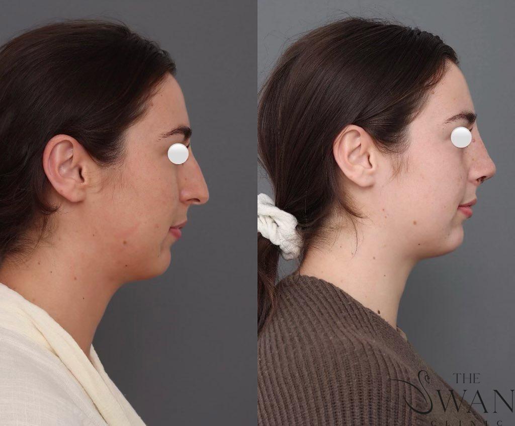 Rhinoplasty - Before and After