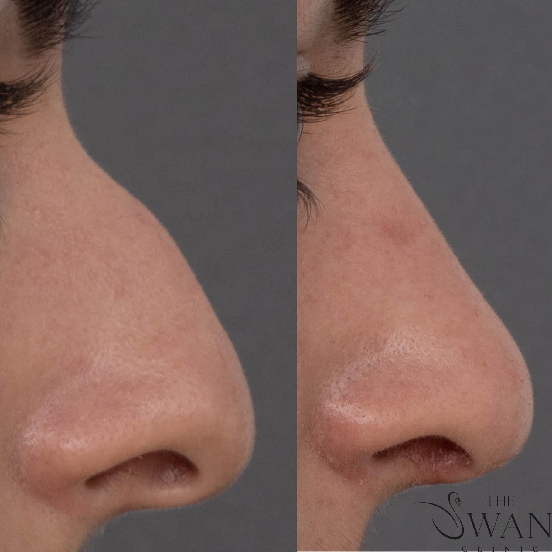 Rhinoplasty - Before and After