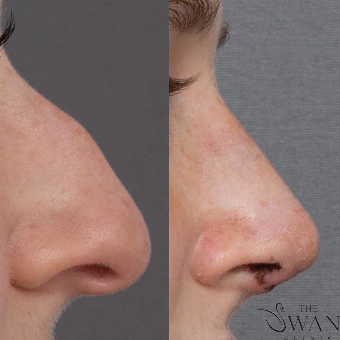 Rhinoplasty - Before and After