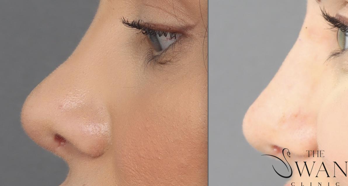 Rhinoplasty - Before and After
